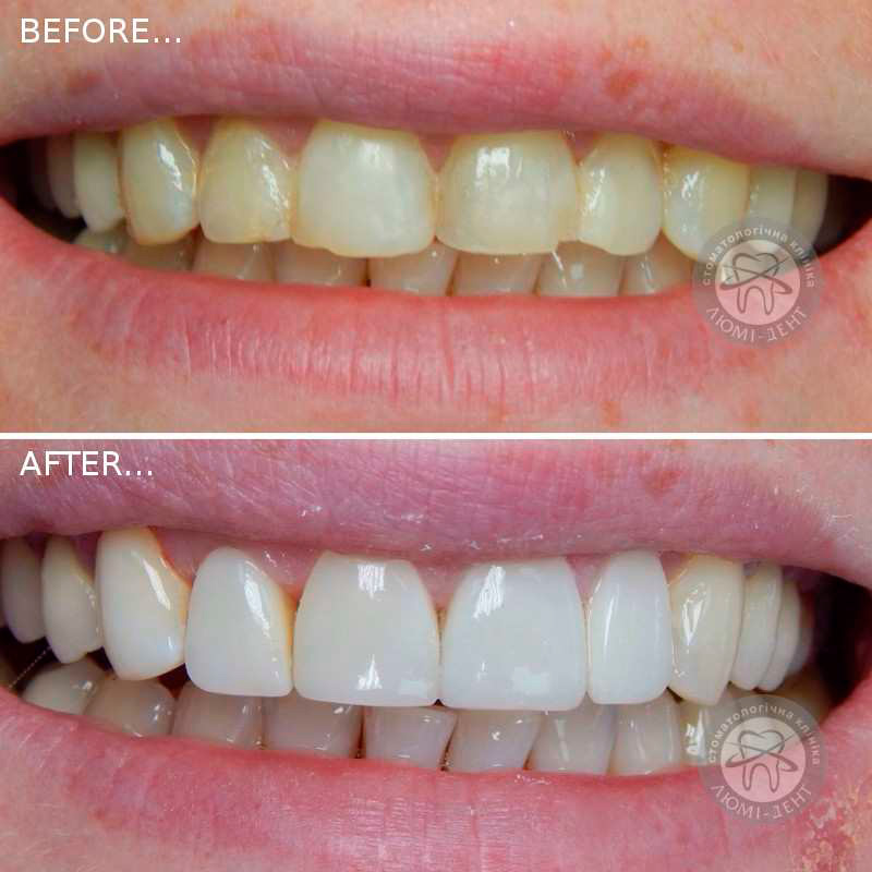 реставрація зубів
