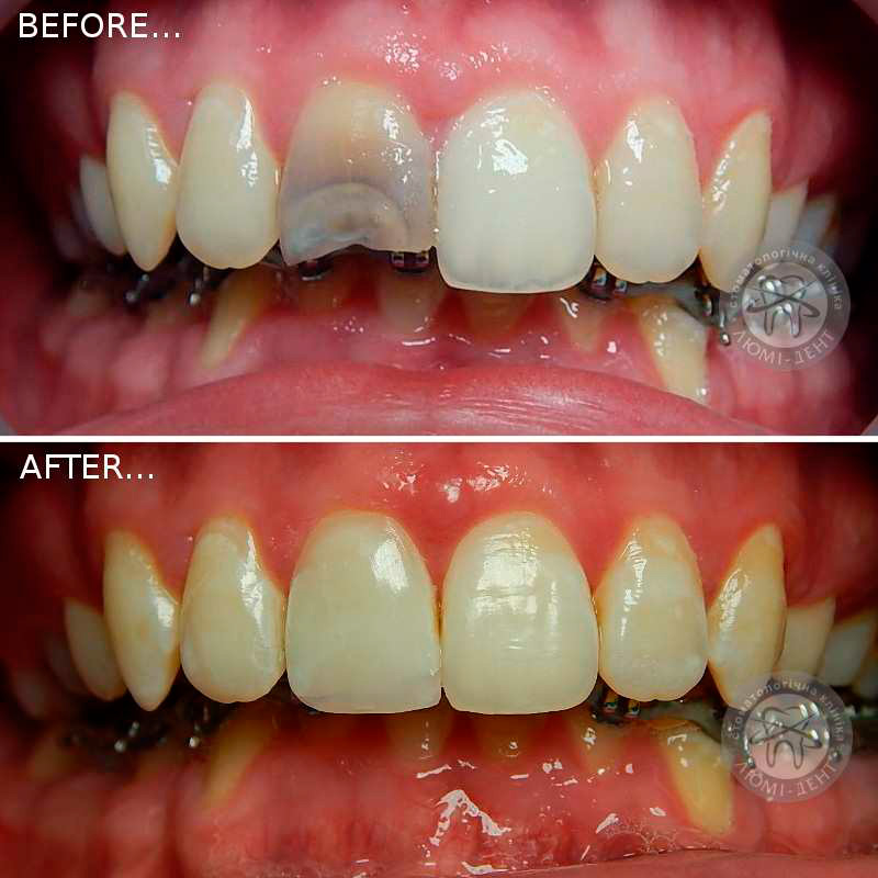 реставрація зубів київ фото люмі-дент