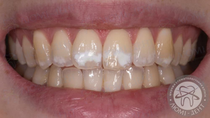 Белые пятна на зубах фото Люми-Дент