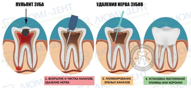Больно ли удалять нерв из зуба после мышьяка фото ЛюмиДент