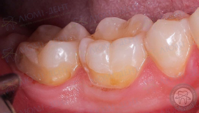 Боль в зубе от сладкого фото Люми-Дент