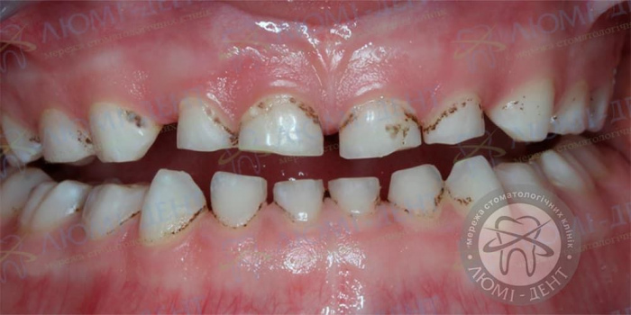 Темные пятна на зубах фото ЛюмиДент