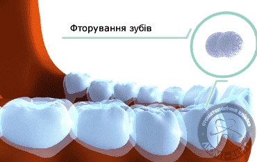 Фторування зубів це фото Люмі-Дент