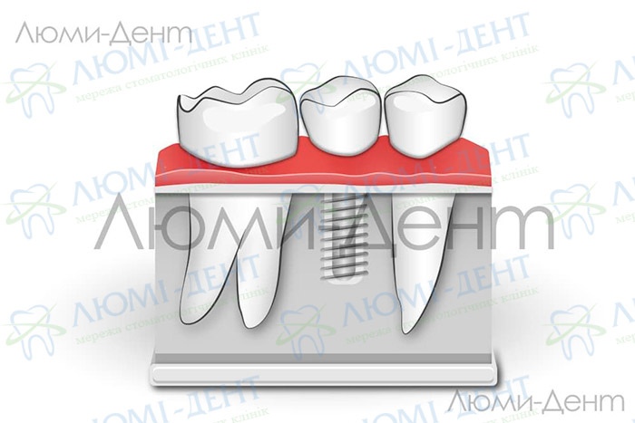 Зубний імплант фото Люмі-Дент