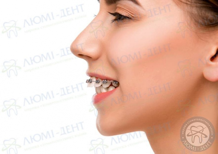Протрузія зуба фото Люмі-Дент