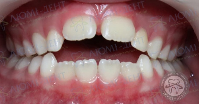 Протрузія зубів це фото Люмі-Дент