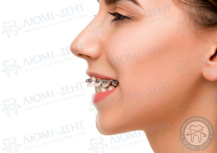Протрузия зуба фото Люми-Дент