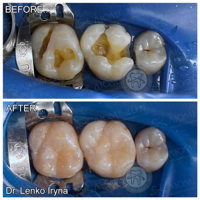 Реставрация зуба фото Люми-Дент