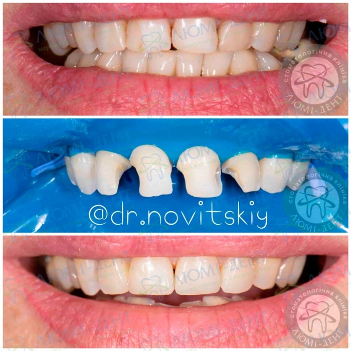 Реставрация зубов фото Люми-Дент