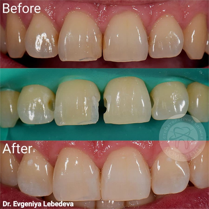 Реставрация зубов фото Люми-Дент