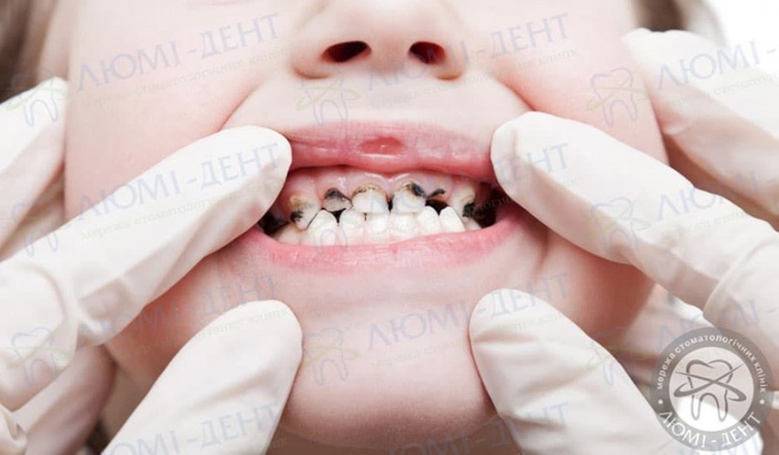 Чому чорніють зуби зсередини фото Люмі-Дент