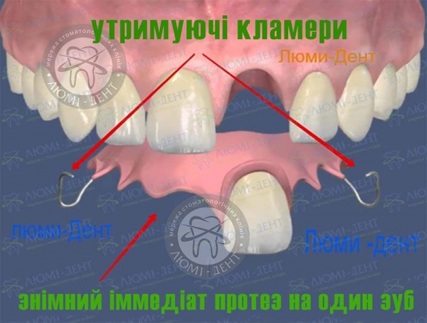 Знімний протез на один зуб фото Люмі-Дент
