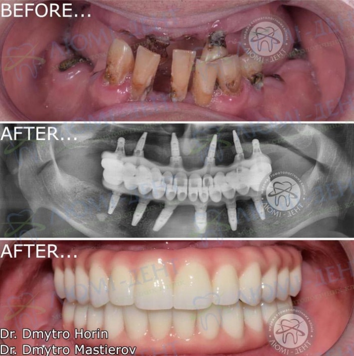 Протезирование зубов цена Киев фото до и после фото Люми-Дент