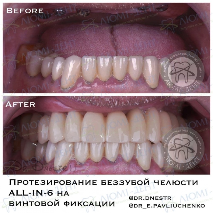 незнімне протезування зубів на імплантах фото Люмі-Дент