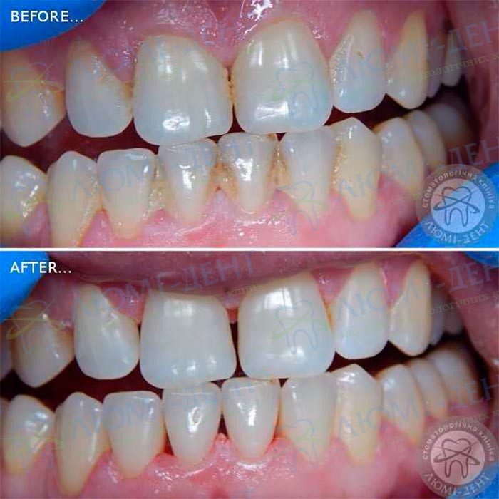 профессиональная чистка зубов у стоматолога  фото ЛюмиДент