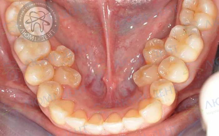 Надкомплектні зуби фото ЛюміДент