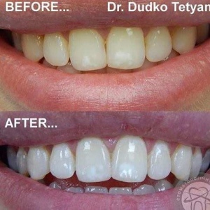  відбілювання зубів київ, фото, до і після