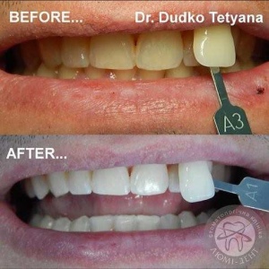  відбілювання зубів київ, фото, до і після