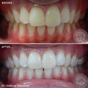 відбілювання зубів київ, фото, до і після