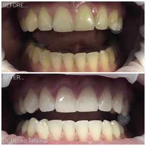 відбілювання зубів київ, фото, до і після