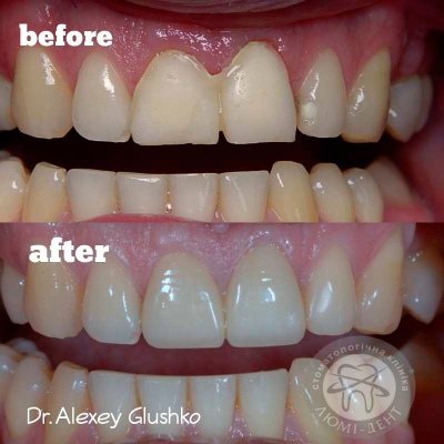 протезирование зубов киев, фото, до и после