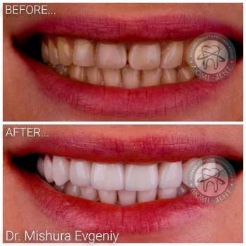 протезирование зубов киев, фото, до и после
