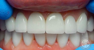 протезирование зубов киев, фото