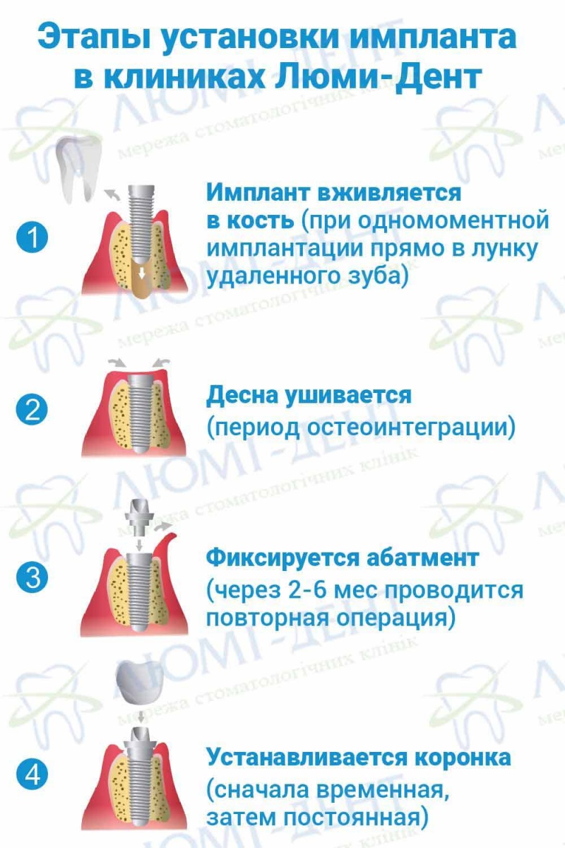 Этапы имплантации зубов фото Люми-Дент 