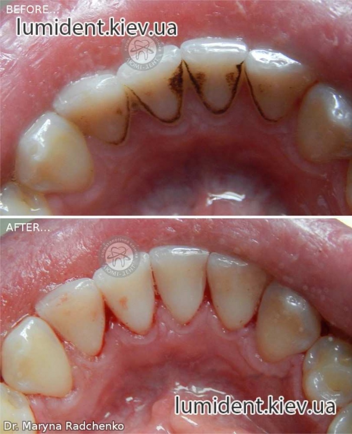 Чистка зубов у стоматолога фото Люми-Дент