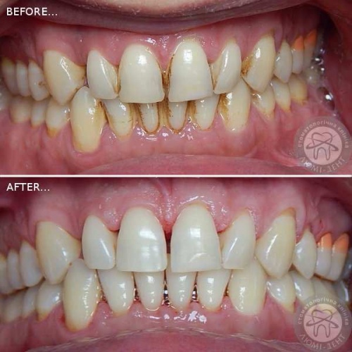 Гигиеническая чистка зубов у стоматолога фото Люми-Дент