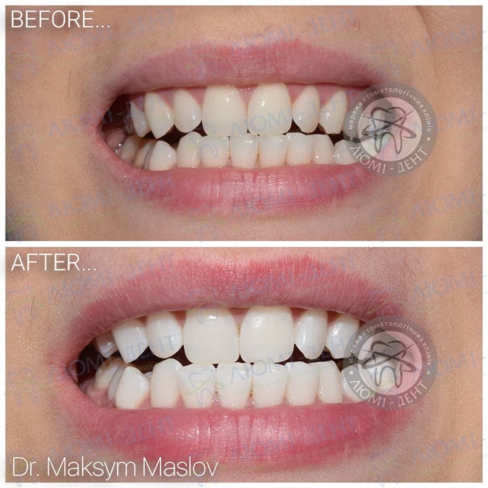 відбілювання зубів плюси і мінуси фото Люмі-Дент