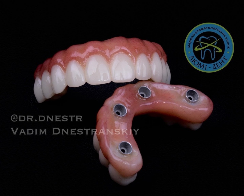 Зубная имплантация фото Люми-Дент