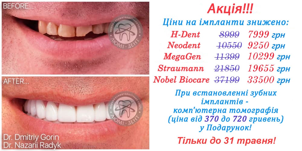 імплант зуба ціна фото Люмі-Дент