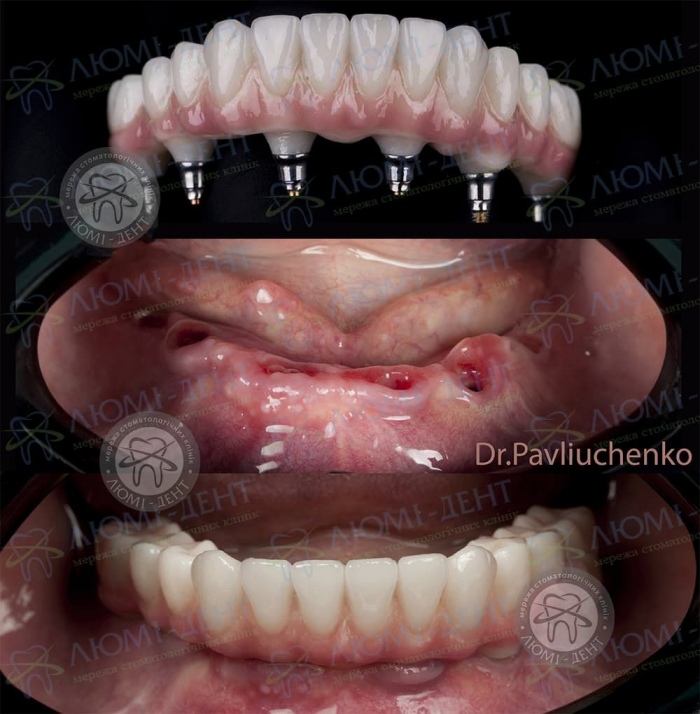 вартість імпланта зуба фото Люмі-Дент