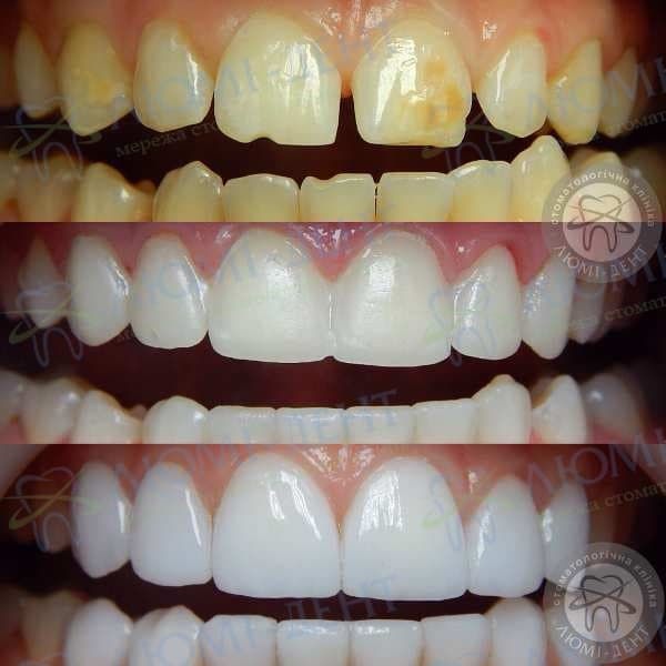 Керамічні зуби ціна фото Люмі-Дент