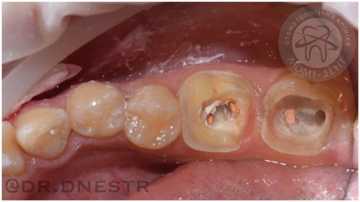 керамічні зуби ціна фото Люмі-Дент