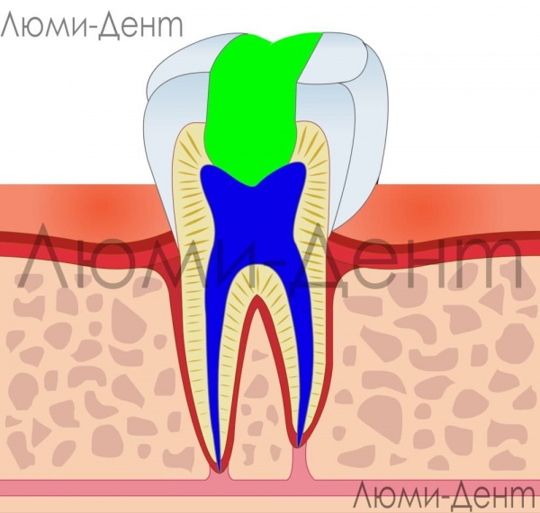 лікування каналів зубів додаткові маніпуляції фото Люмі-Дент