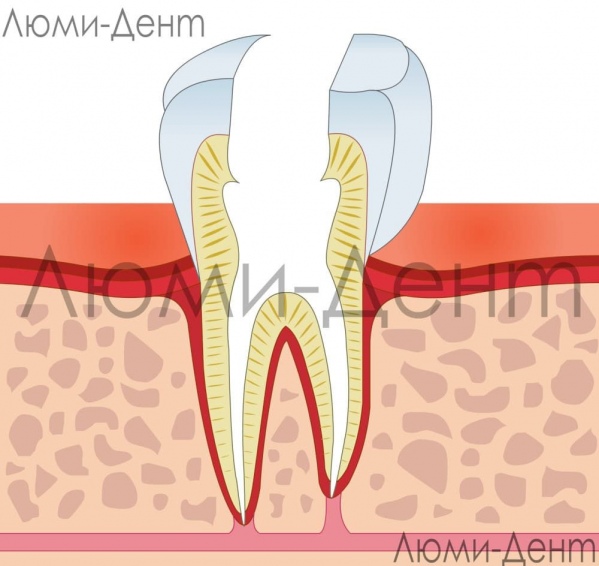 видалення нерва зуба лікування каналів фото Люмі-Дент