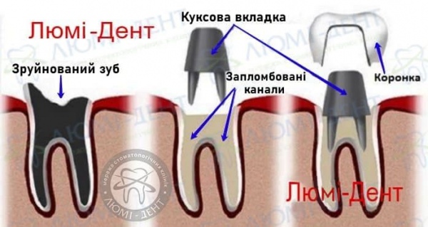 металокерамічна коронка на зуб фото Люмі-Дент