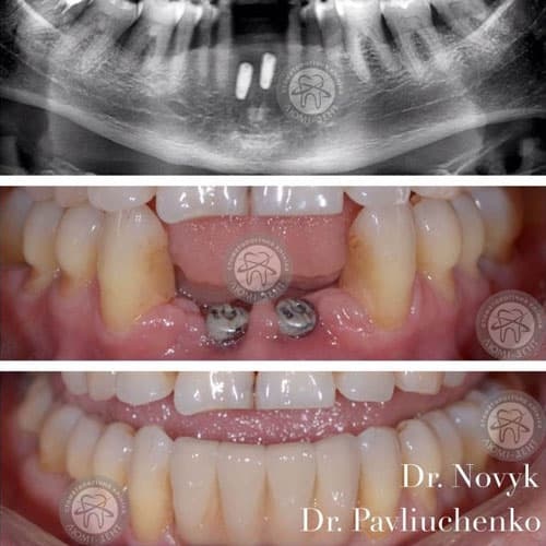 зуби із металокераміки фото Люмі-Дент
