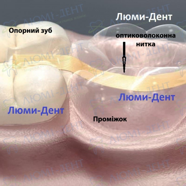 зубна вкладка на зуби фото Люмі-Дент