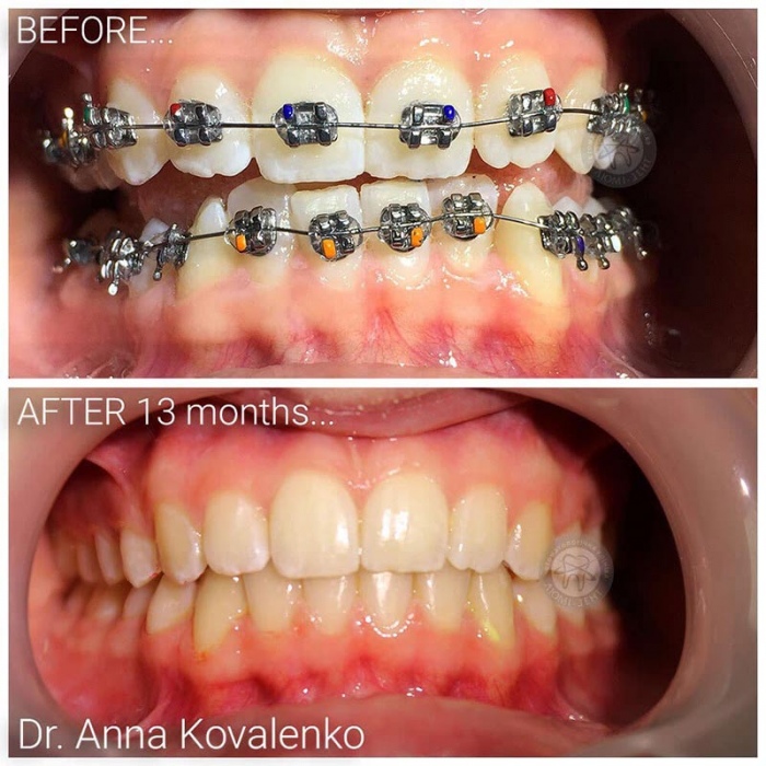 Ортодонт стоматолог детский врач исправление прикуса Киев фото Люми Дент 
