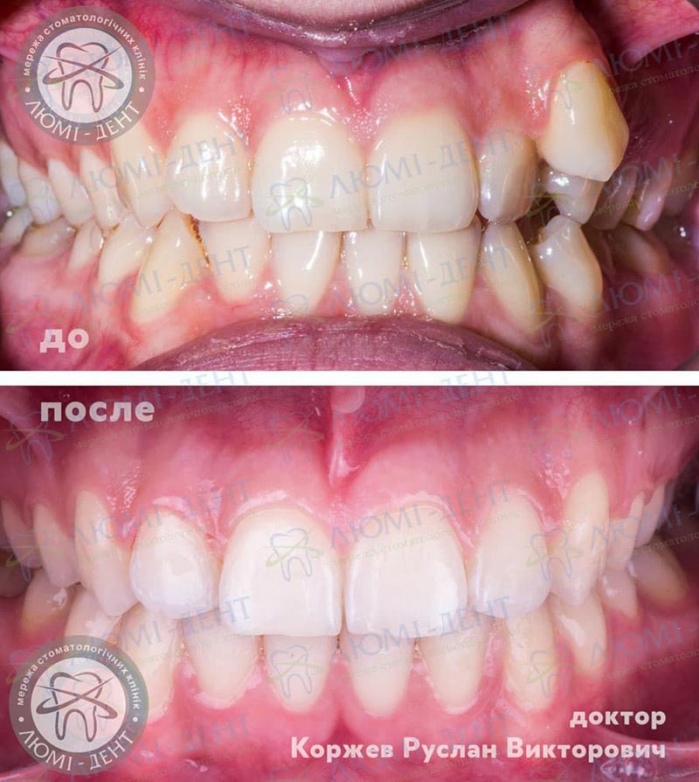 Ортодонт стоматолог исправление прикуса фото Киев Люми-Дент