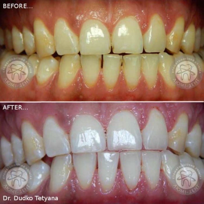 Відбілювання зубів ціна фото Люмі-Дент