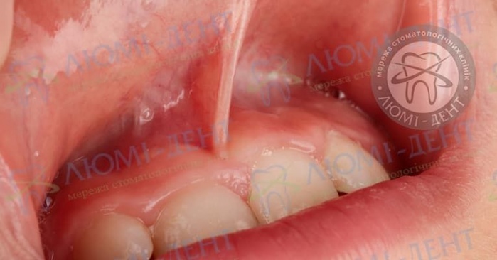 Підрізання вуздечки верхньої губи відгуки фото Люмі-Дент