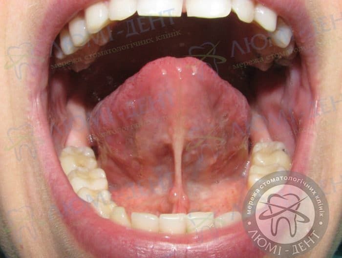 Підрізання вуздечки язика фото Люмі-Дент