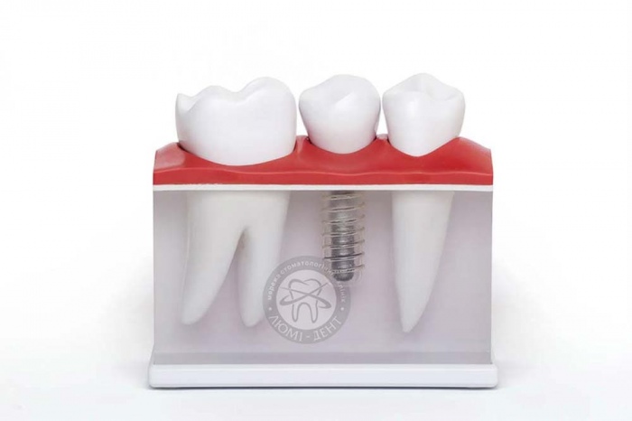 Імплантація зубів за і проти фото Люмі-Дент