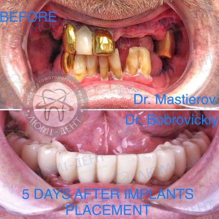 Незнімне протезування зубів на імплантах фото Люмі-Дент