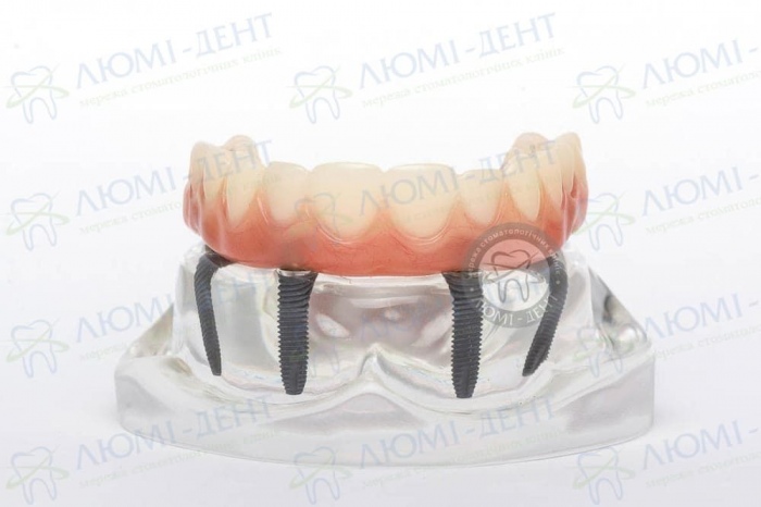 Знімні зубні протези на імплантах ціна фото Люмі-Дент