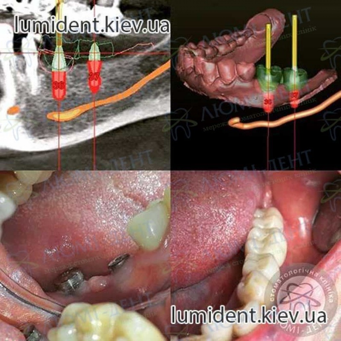 Зубні протези на імплантах фото Люмі-Дент